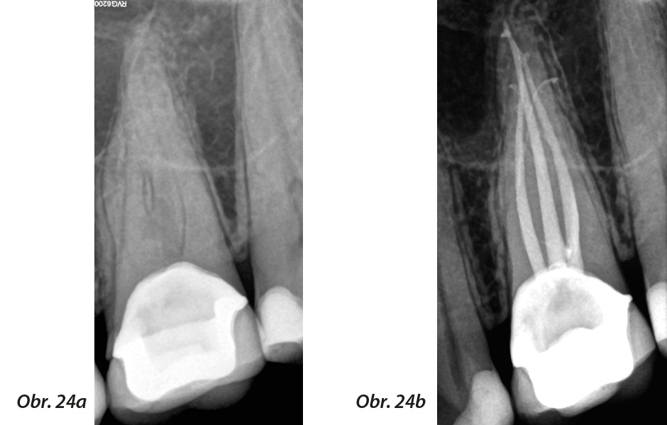 a) Preoperační periapikální rentgen; b) pooperační rentgenový snímek poté, co byly kanálky vypracovány jedním nástrojem WaveOne Gold Primary a poté byly zaplněny