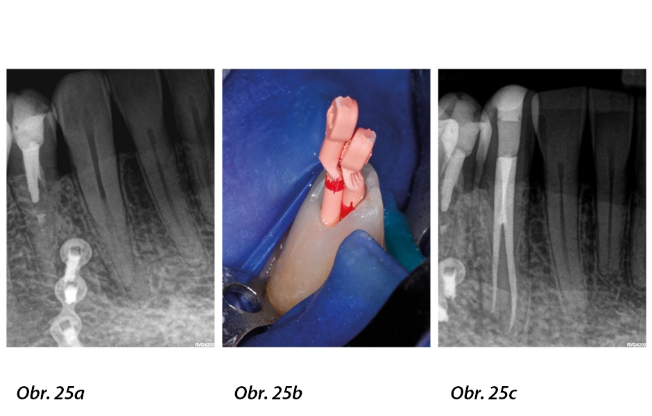 Obr. 25: a) Preoperační periapikální rentgen – všimněte si bifurkace ve střední třetině kanálku špičáku. b) Dva gutaperčové čepy WaaveOne Gold Primary dosazené skrze labiální přístupovou kavitu c) Konečný výsledek po zaplnění kořenového kanálku
