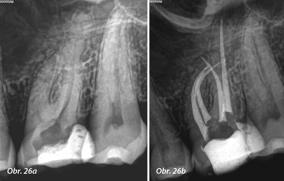 Obr. 26: a) Preoperační periapikální rentgenové vyšetření ukázalo, že zub byl dříve akutně endodonticky ošetřen; b) pooperační rentgen poté, co byly čtyři kanálky vypracovány s jediným nástrojem WaveOne Gold Primary a následně zaplněny