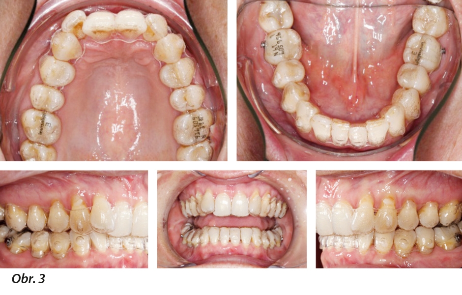 Intraorální snímky ortodontického fóliového aparátu 19 in situ, na kterém je vidět dobré umístění