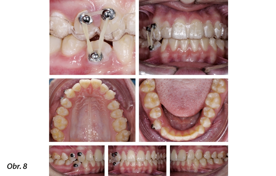 Knofl íky a gumičky na místě s ortodontickými fóliovými aparáty Invisalign® během léčby