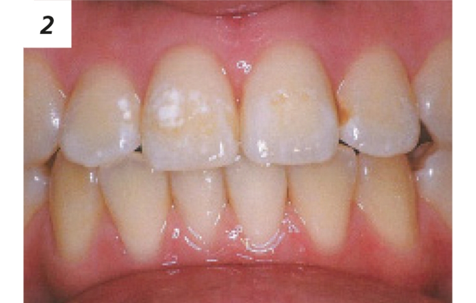 Klinický případ: Dívka, 18 let, se dostavila s částicemi cementu na zubech po odlepení ortodontických zámků na jiném pracovišti.