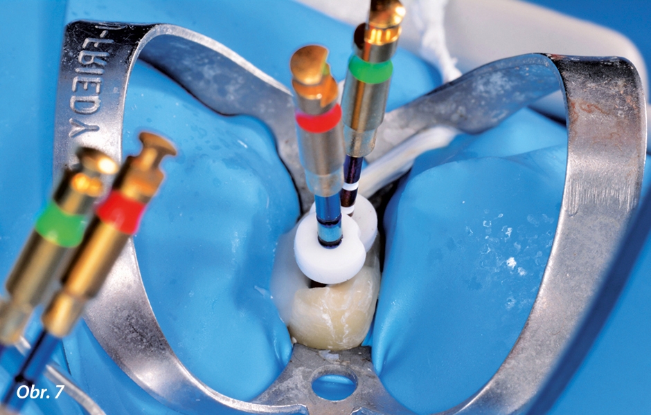 Klinické použití vysoce flexibilních nástrojů pro běžnou i složitější endodoncii<br>Nové endodontické nástroje Unicone PLUS
