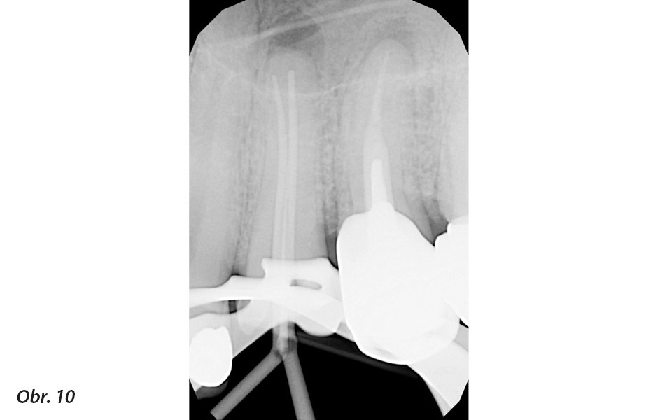 Klinické použití vysoce flexibilních nástrojů pro běžnou i složitější endodoncii<br>Nové endodontické nástroje Unicone PLUS