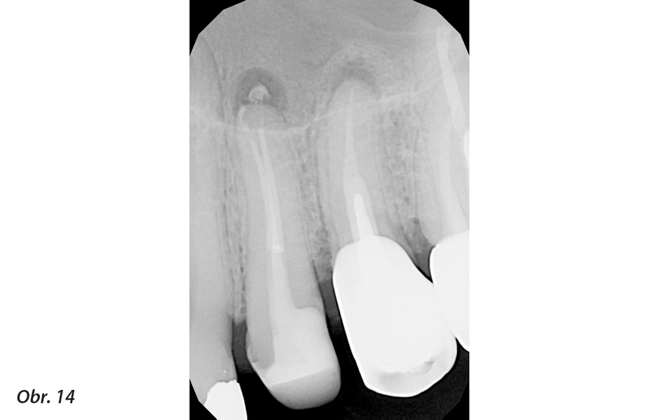 Klinické použití vysoce flexibilních nástrojů pro běžnou i složitější endodoncii<br>Nové endodontické nástroje Unicone PLUS