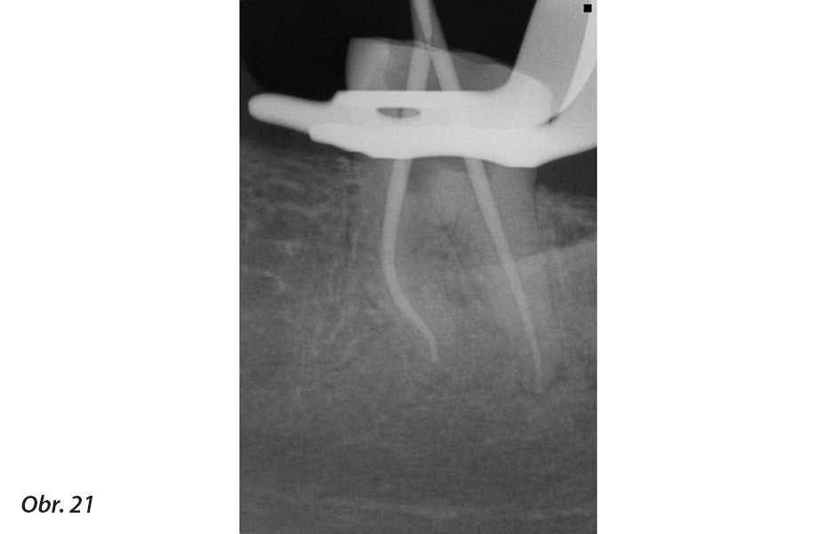 Klinické použití vysoce flexibilních nástrojů pro běžnou i složitější endodoncii<br>Nové endodontické nástroje Unicone PLUS