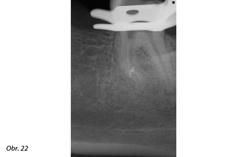 Klinické použití vysoce flexibilních nástrojů pro běžnou i složitější endodoncii<br>Nové endodontické nástroje Unicone PLUS