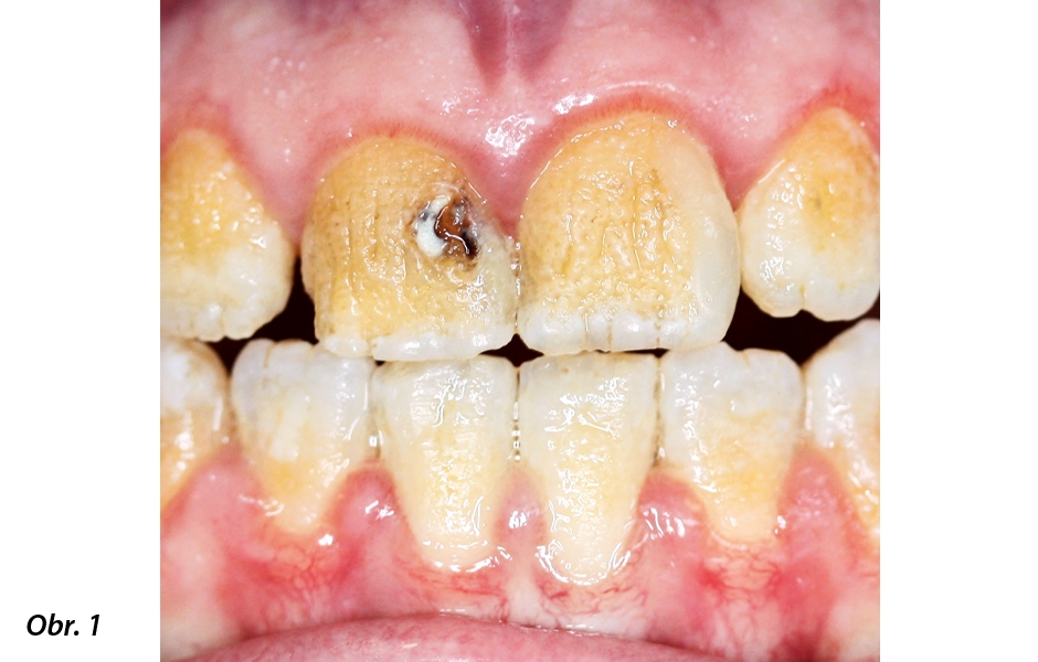 Tři fenotypy autozomálně dominantní dědičné amelogenesis imperfecta u frontálních zubů tří sester.