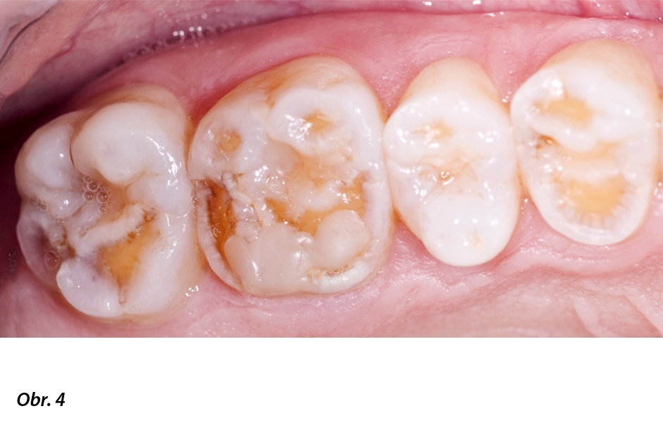 Distální zuby pacientů s amelogenesis imperfecta také vykazují různé defekty skloviny – sklovinná vrstva může i zcela chybět.