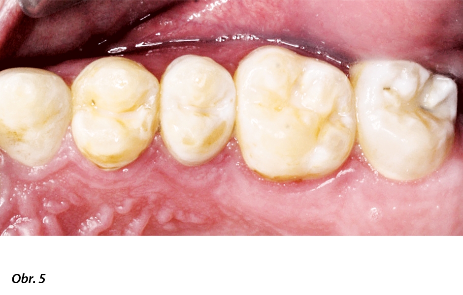Distální zuby pacientů s amelogenesis imperfecta také vykazují různé defekty skloviny – sklovinná vrstva může i zcela chybět.