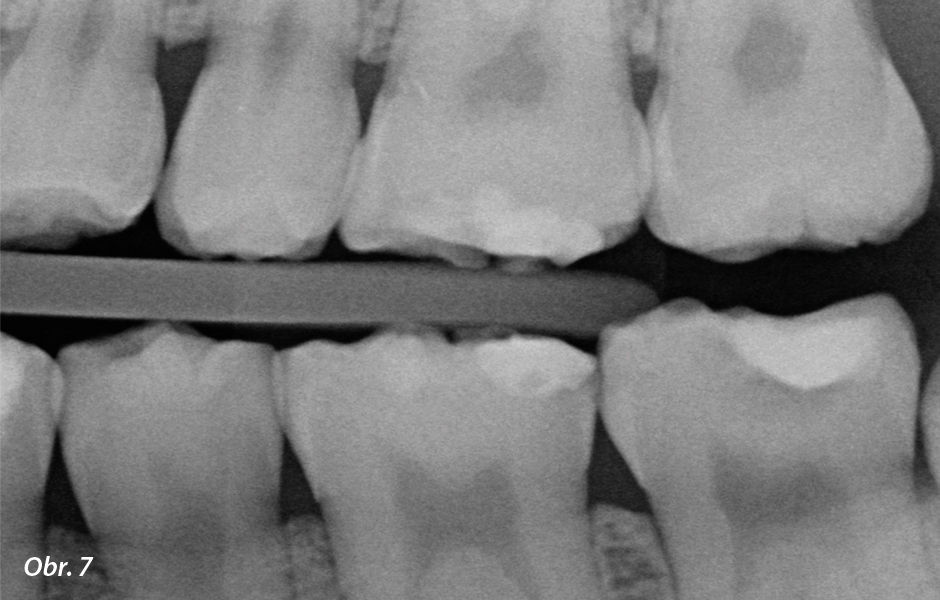 Chybí celá korunka zubu 23 (obr. 6). RTG snímek typu bite-wing (obr. 7) zachycuje normálně tvarovaný dentin: některé jeho části jsou obnažené, jiné jsou překryty jen tenkou vrstvou skloviny.