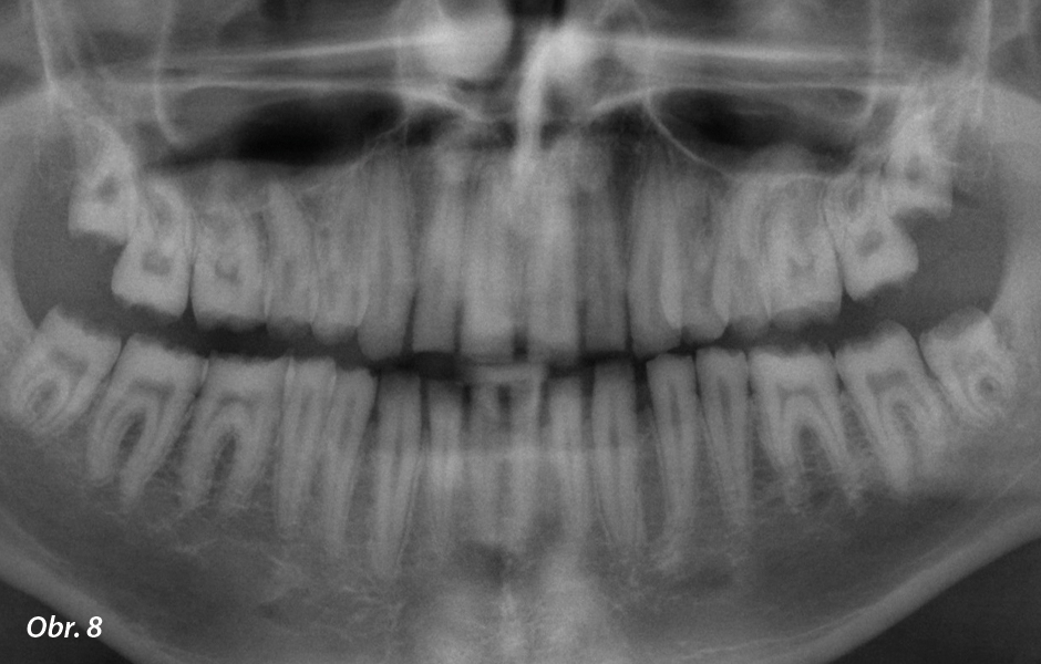 Panoramatický RTG snímek vykazuje vážnou formu amelogenesis imperfecta – žádný ze zubů není překryt vůbec žádnou sklovinou.