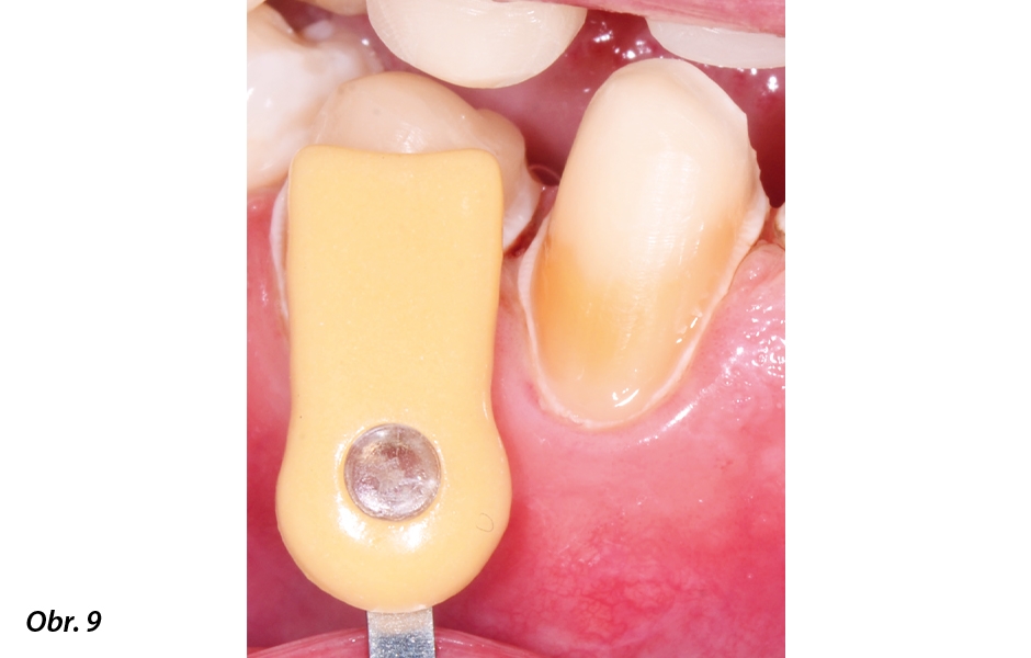 V mnoha případech se barva dentinu podstatně liší od normálu – je proto důležité zvolit správný odstín zubu pro estetický výsledek monolitických korunek.