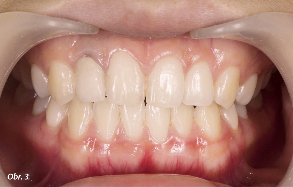 Diskolorace zubu 12
