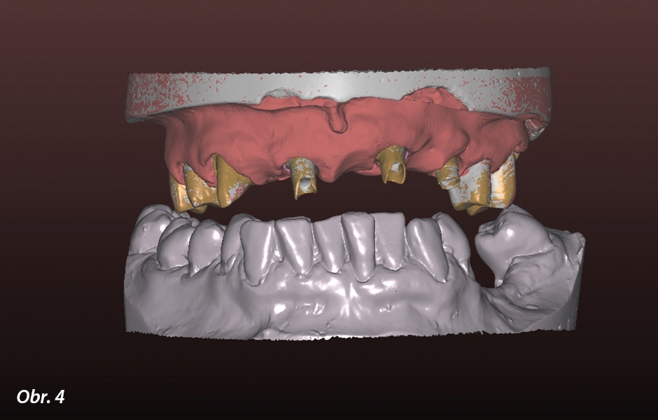 Kombinace zubů a implantátů – plně anatomické náhrady z PRETTAU® 2 ZIRCONIA