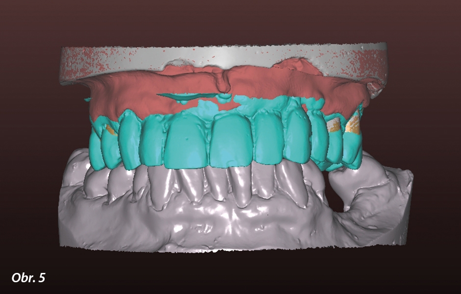 Kombinace zubů a implantátů – plně anatomické náhrady z PRETTAU® 2 ZIRCONIA