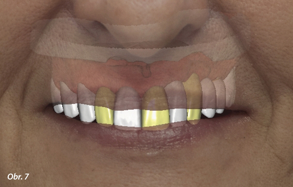 Kombinace zubů a implantátů – plně anatomické náhrady z PRETTAU® 2 ZIRCONIA