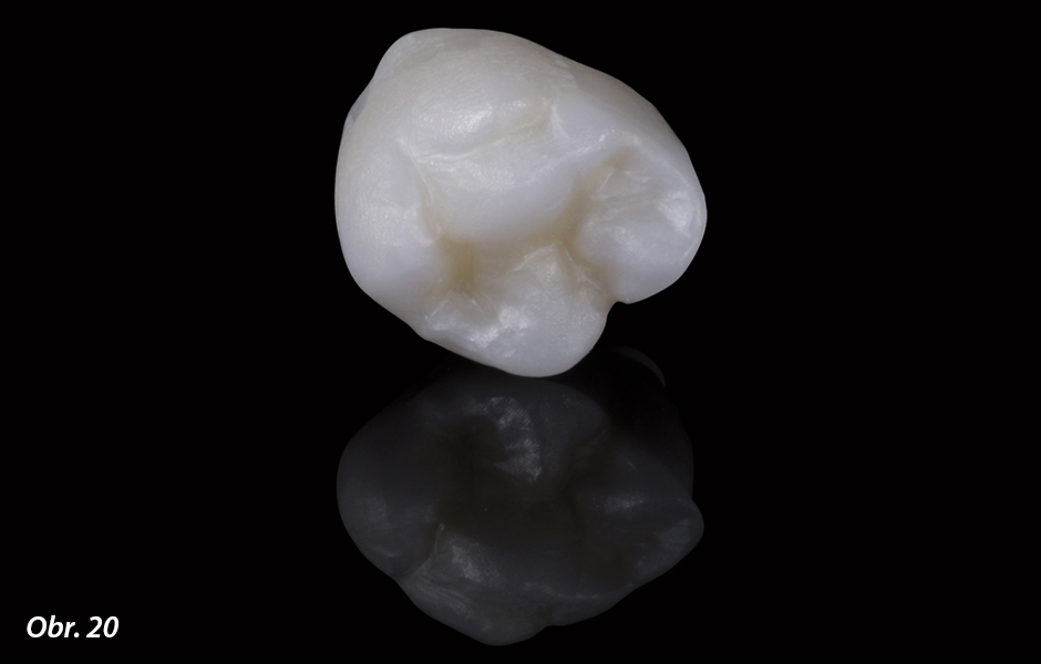 Kombinace zubů a implantátů – plně anatomické náhrady z PRETTAU® 2 ZIRCONIA