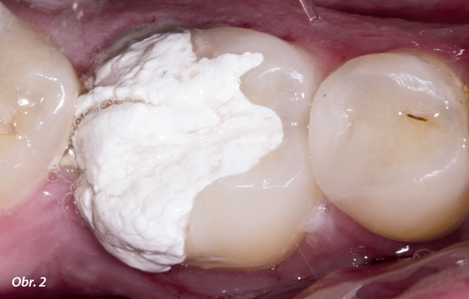 Provizorní dostavba na zubu 46 – pacient odeslán k endodontistovi