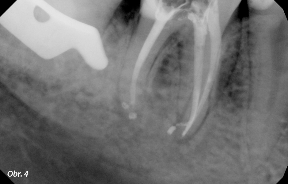 Kontrolní RTG snímek pořízený po plnění kořenových kanálků