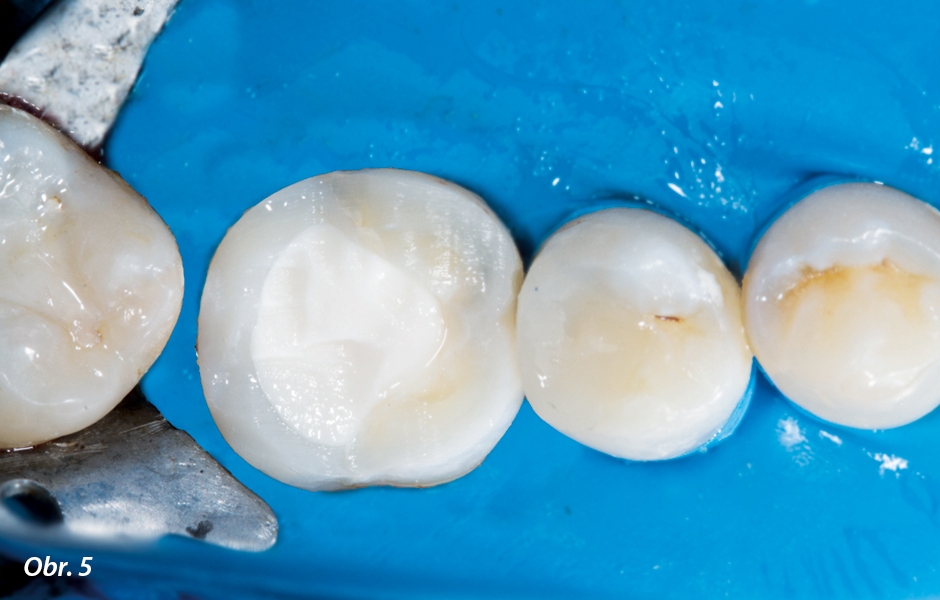 Dočasná dostavba zubu po ošetření – zub vyřazen z okluze