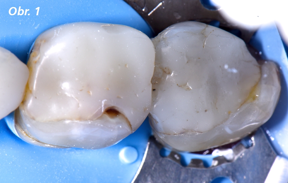 Situace před ošetřením vykazující rozsáhlé výplně a minimální zbytkovou zubní strukturu