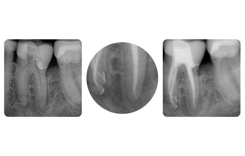 Příklad ošetření dolního moláru. Zde byl systém kanálků po úspěšném opracování dostatečně vypláchnut v celém rozsahu pomocí roztoků EDTA a NaOCl. Následně byly otevřeny i postranní kanálky a rozpuštěny zbytky tkání v nich obsažené.