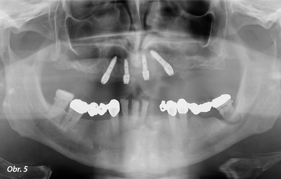 CT sken po chirurgickém zavedení čtyř implantátů v horní čelisti