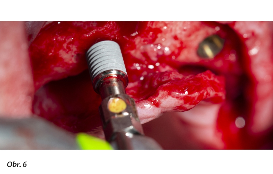 Chirurgická procedura zavádění implantátů
