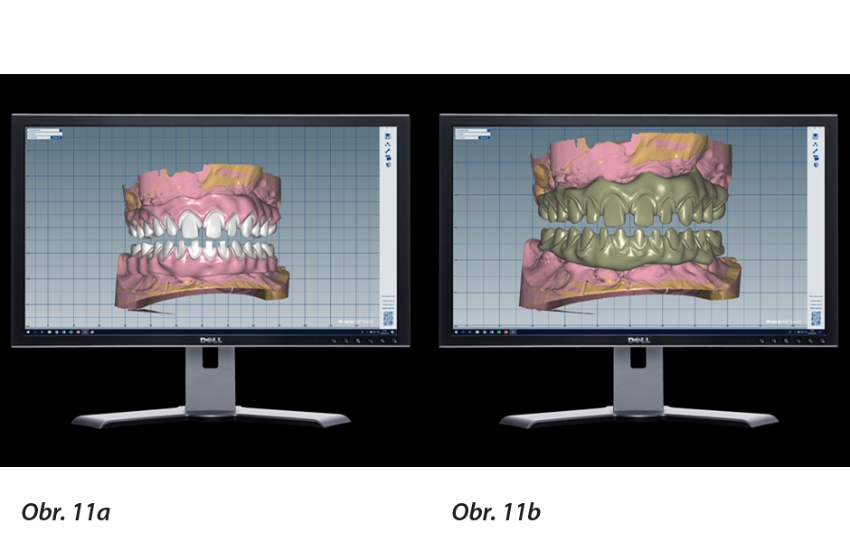 CAD design definitivních náhrad