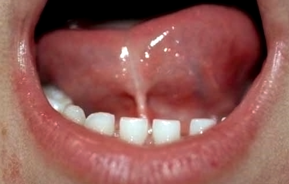 Obr. 1: Podjazyková uzdička neboli frenulum sublinguale – třetí stupeň postižení