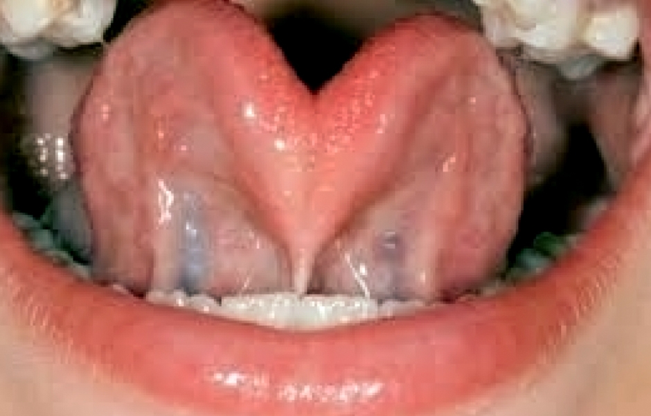 Obr. 2: Obrázek 2: Uzdička jazyka – čtvrtý stupeň postižení (ankyloglosie)