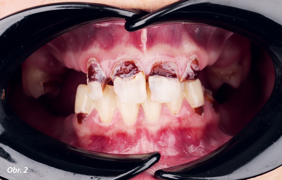 Vážně poškozené zbývající zuby