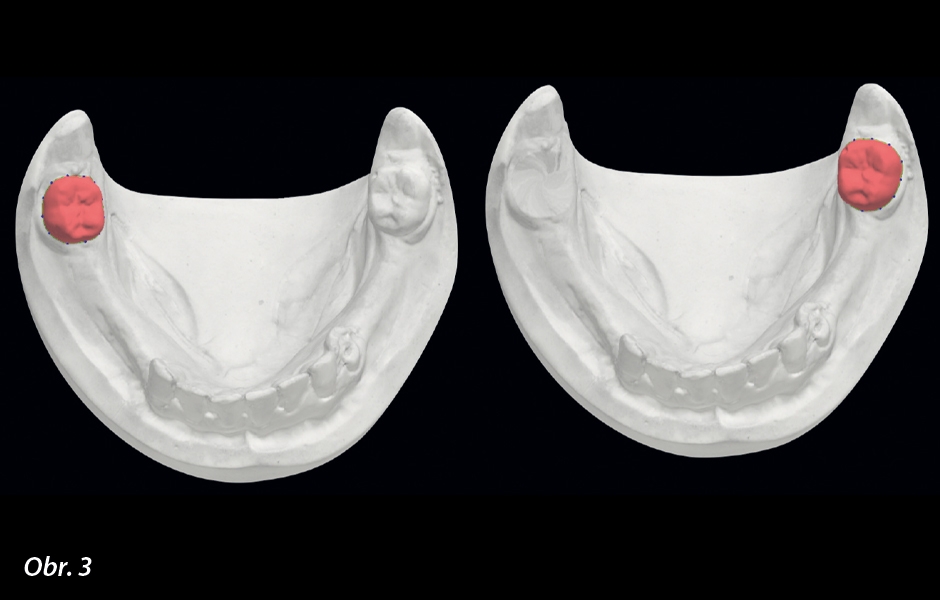 Virtuální extrakce stávajících zubů v softwaru