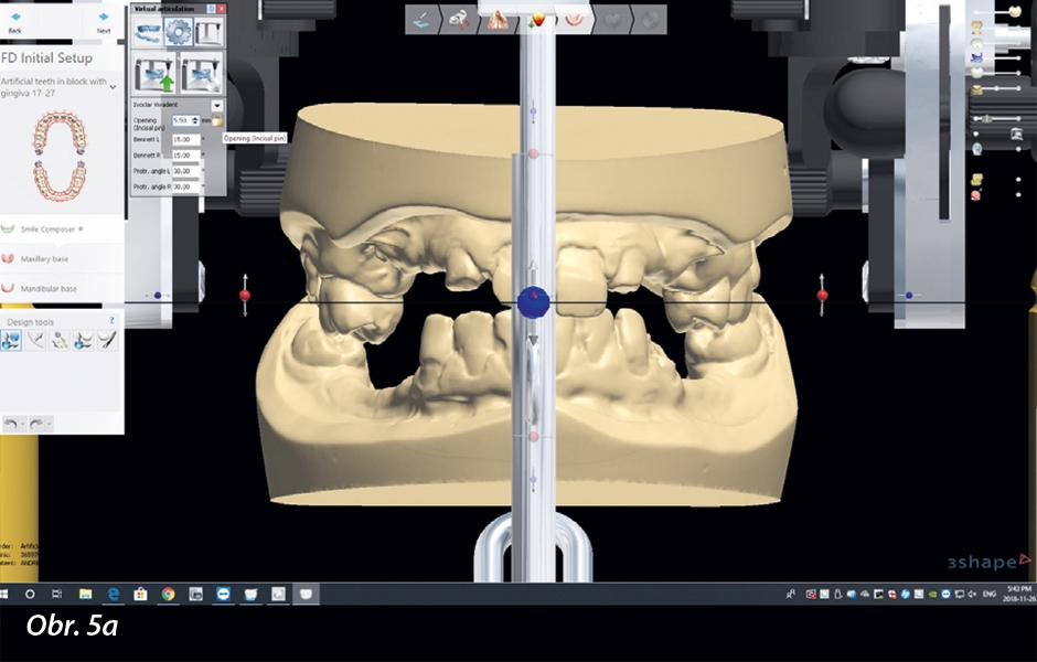 Otevření vertikálního rozměru o 5,5 mm a volba tvaru zubů v knihovně Digital Denture Full Arch