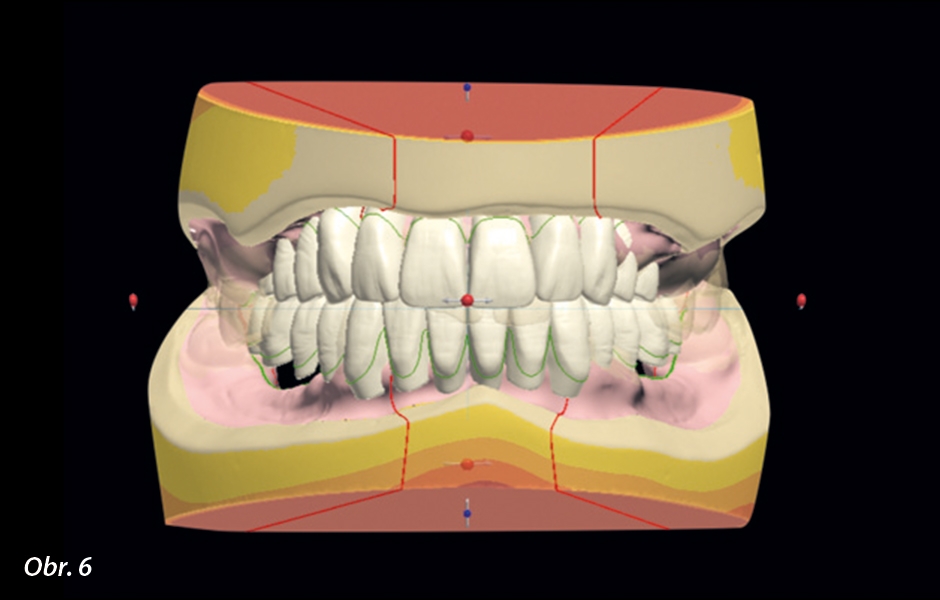 Software automaticky vytvoří návrh postavení zubů