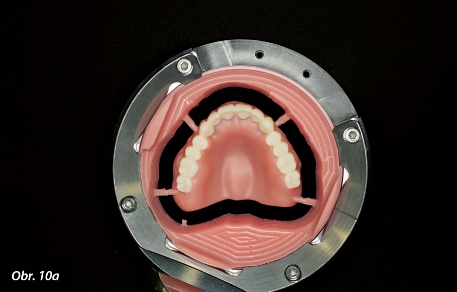 Horní provizorní náhrada po spojení zubního oblouku s bází náhrady – translucentní vlastnosti incizální oblasti jsou pozoruhodné