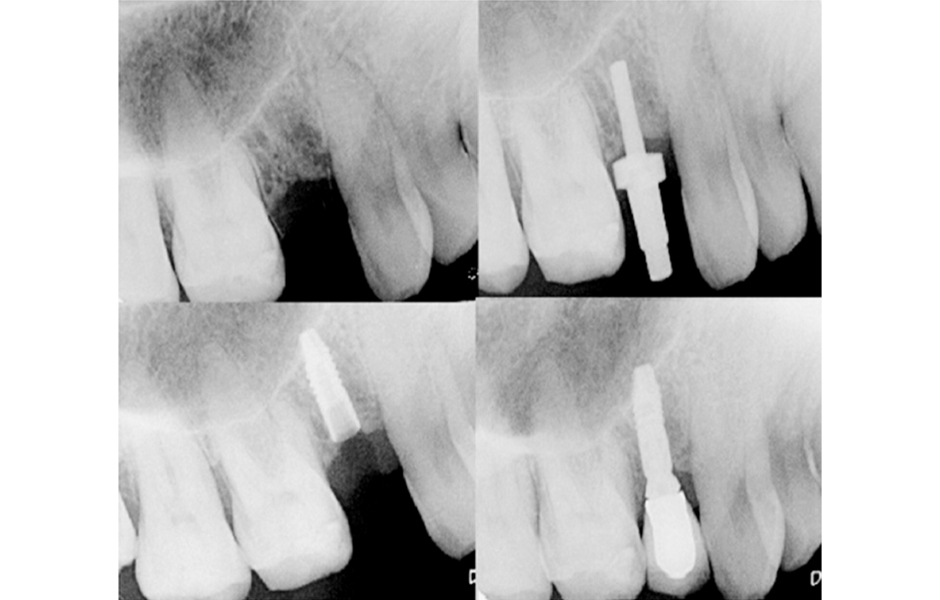 Předoperační rentgenový snímek, snímek s měrkou zavedenou in situ, snímek ihned po implantaci, zkouška korunky