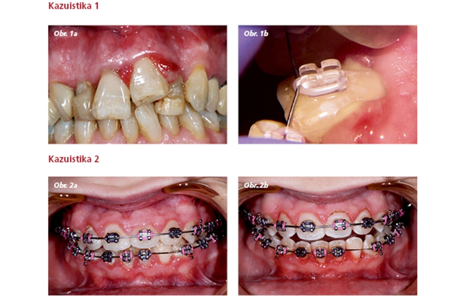 Obr. 1a–b: Traumatická intruze, laser byl použit před ortodontickou extruzí kvůli možným bolestem  Obr. 2a: Hyperplazie gingivy před ošetřením  Obr. 2b: Okamžitě po ošetření