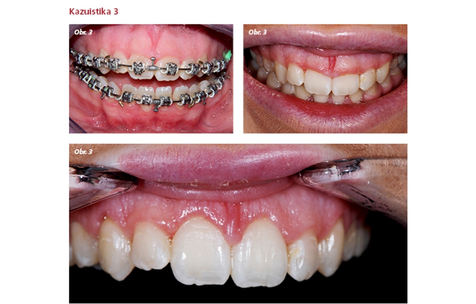 Obr. 3a: Gummy smile  Obr. 3b: Po ortognátní chirurgii  Obr. 3c: Gingivoplastika týden po operaci