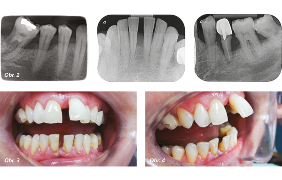 Obr. 2: Intraorálne rtg snímky, Máj 2015  / Obr. 3, 4: Fotodokumentácia, postavenie d№21 mimo zubný oblúk v maxile, Máj 2015