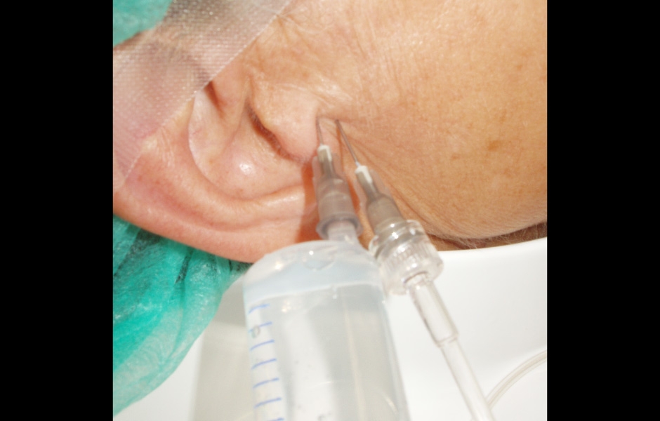 Obr. 1: Artrocentéza, zavedení 2 jehel do kloubního prostoru.