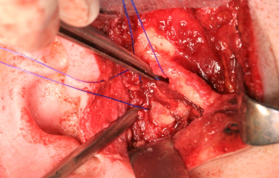 Obr. 10: Náhrada disku lalokem z m. temporalis.