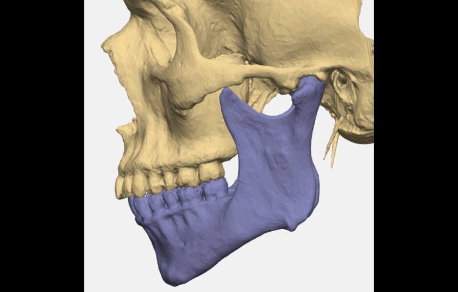 Obr. 11: Virtuální plánování totální náhrady – osteoartróza TMK vlevo.