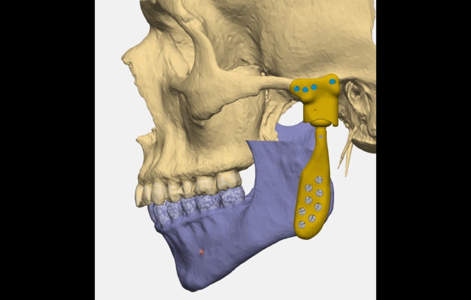 Obr. 12: Virtuální plánování totální náhrady – plán resekce a komponent náhrady.
