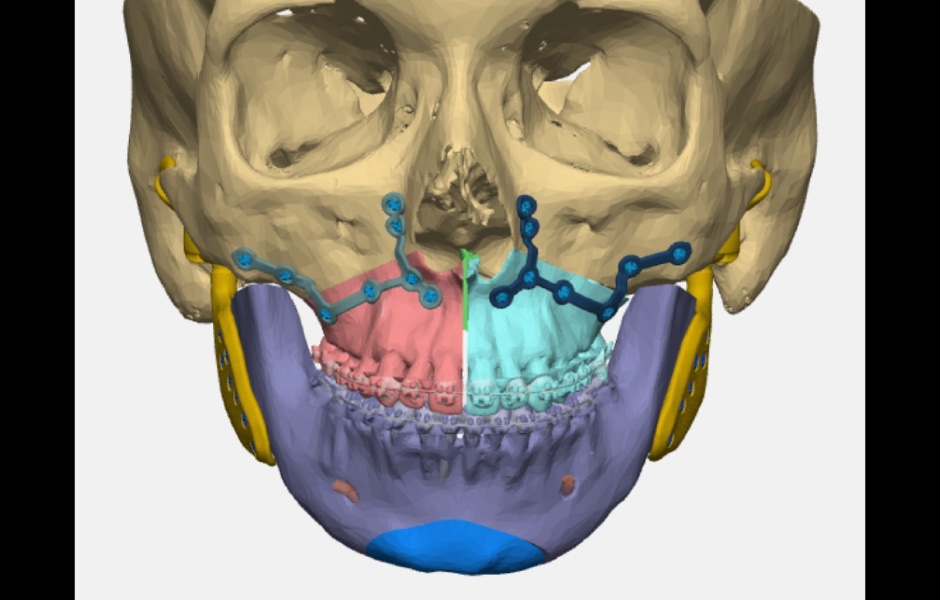Obr. 13: Virtuální plánování kombinované TEP + ortognátní operace.