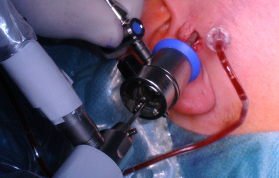 Obr. 3: Zavedení artroskopu.