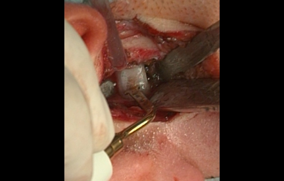 Obr. 4: Provádění kondylárního shavingu.