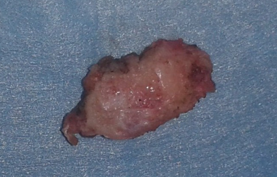 Obr. 5: Odstraněná část hlavice při kondylárním shavingu.