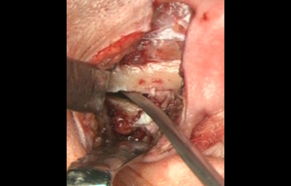 Obr. 6: Provádění eminektomie.